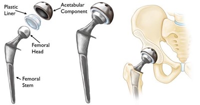 Picture of total hip joint replacement