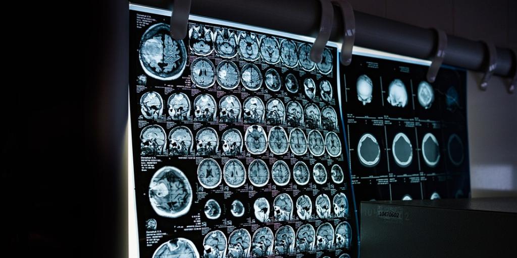 Image of a Computerized Tomography (CT) scan
