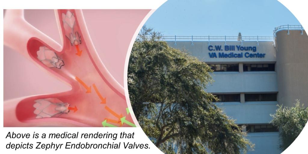 A graphic rendering of the C.W.Y. VAMC next to a medical rendering of the valves that were used during a Bronschopic Lung Volume Reduction surgery.