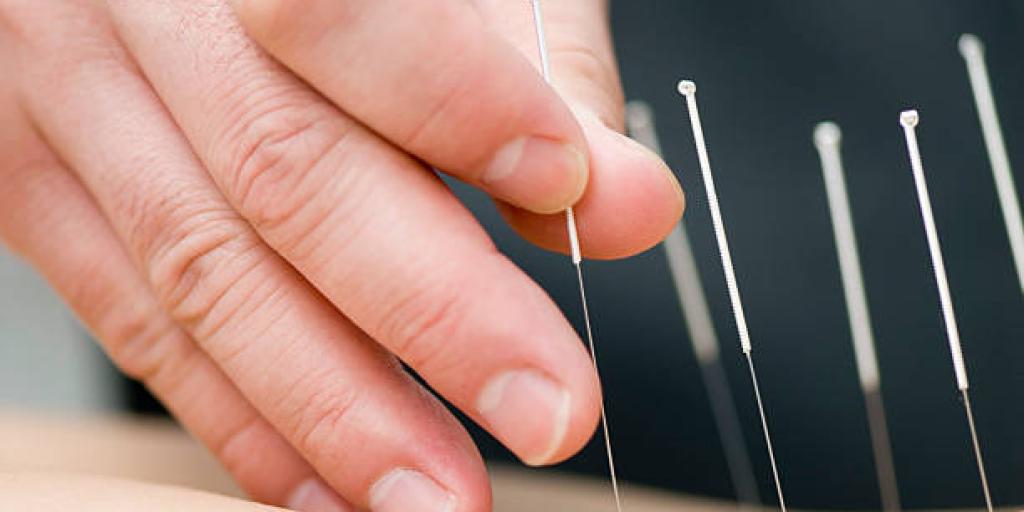 hand placing acupuncture in persons back